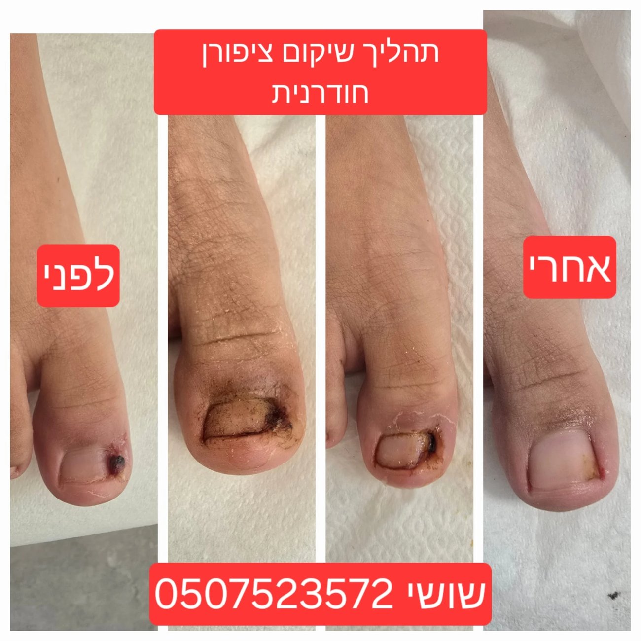 תהליך שיקום ציפורן חודרנית: לפני, במהלך השיקום, ואחרי